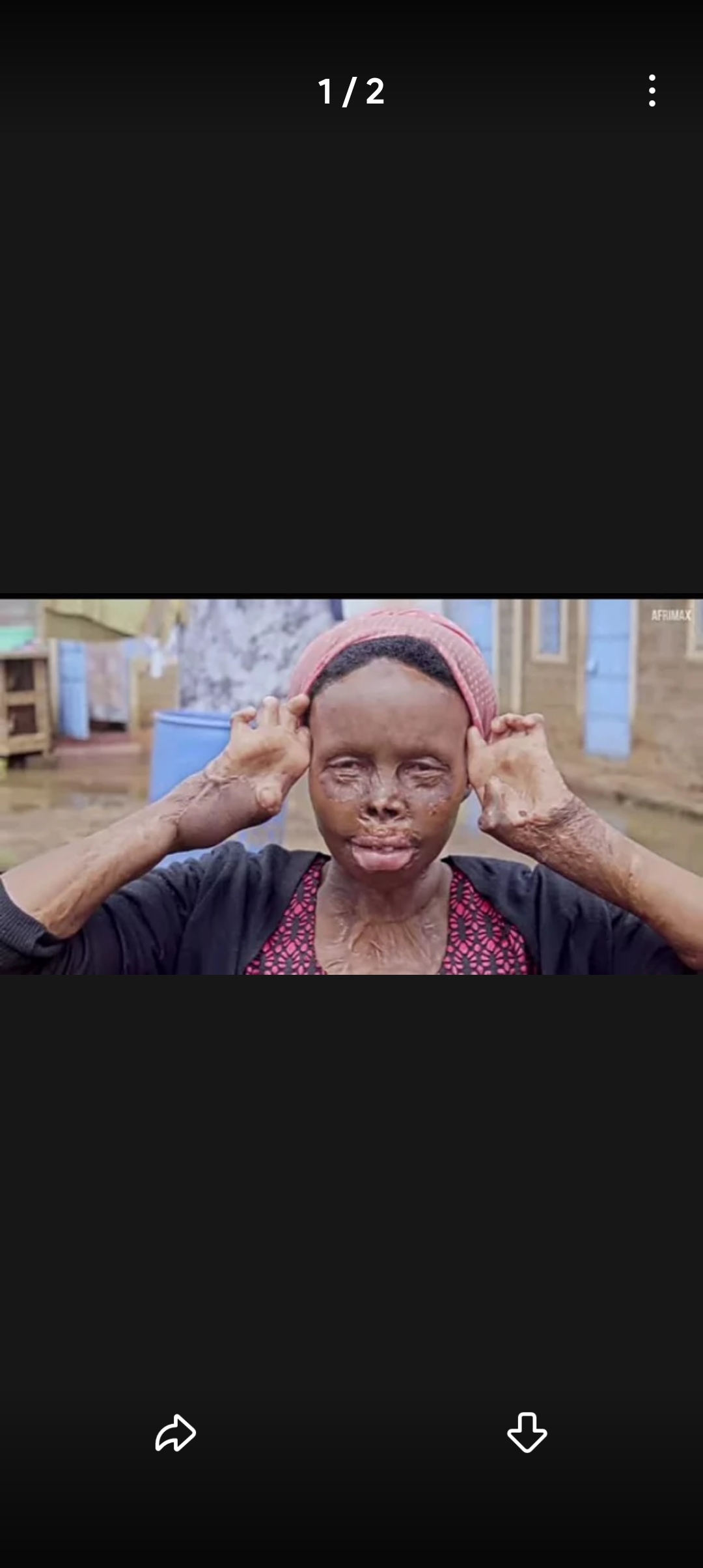 Sad: My husband  burnt me and disappear. 